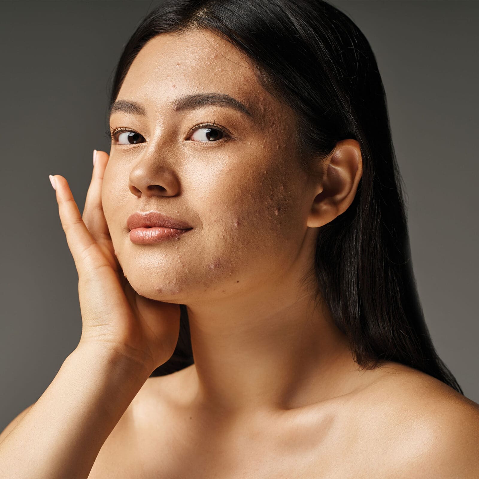 How to Get Rid of Cystic Acne Once and For All, According to Dermatologists