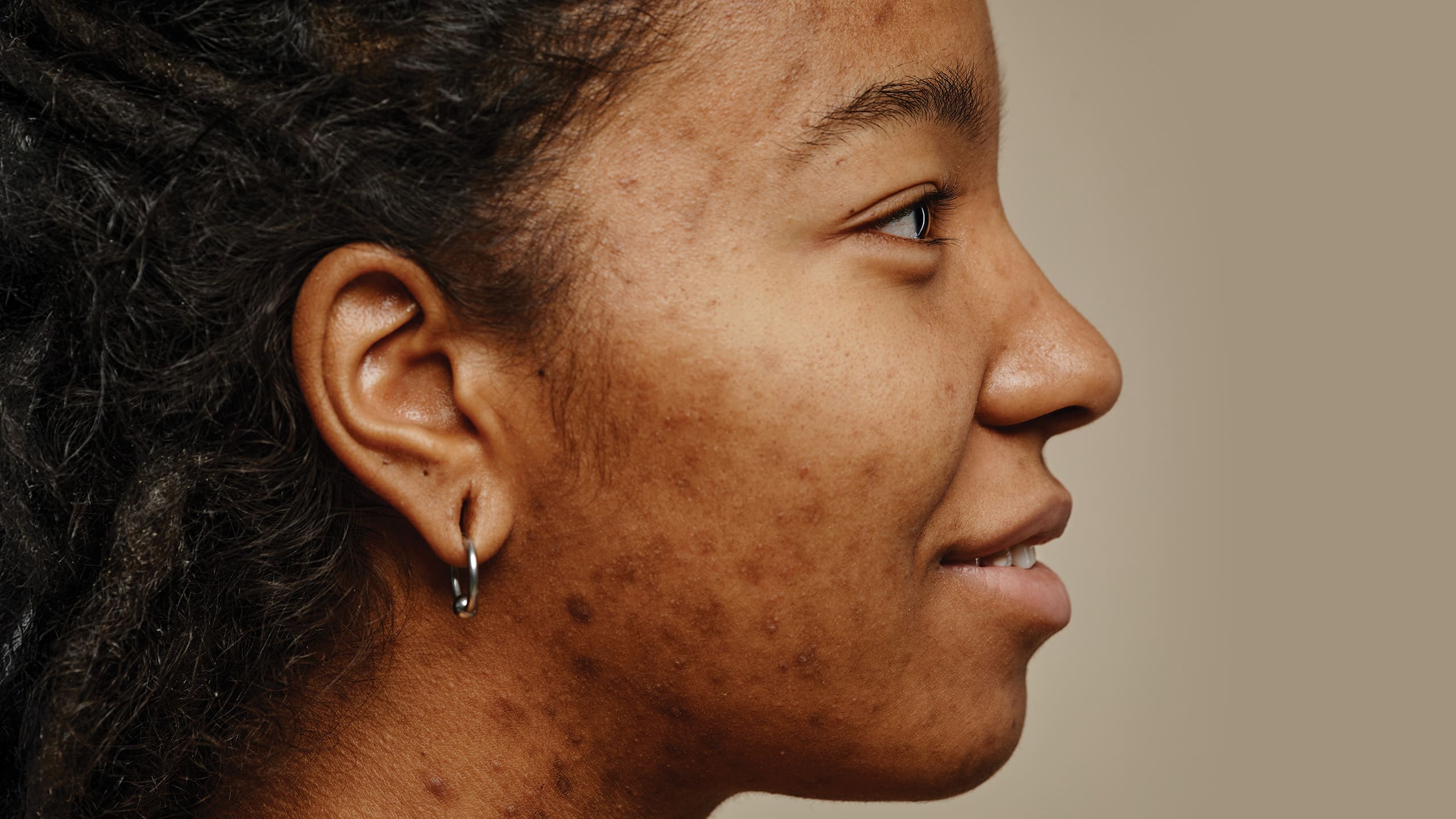 How to Treat Acne and Dark Spots on Morena Skin